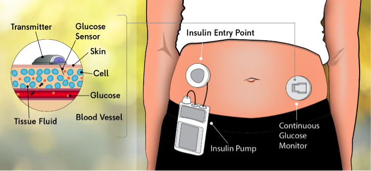 CGMS sensorinsertion