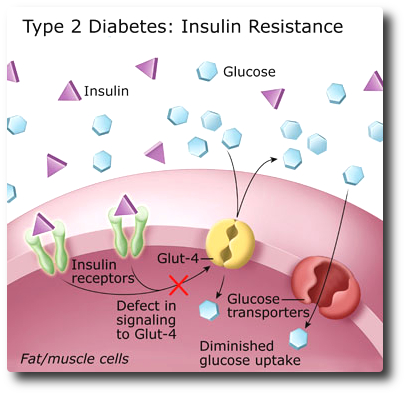 Type 2 Diabetes : how it occurs?